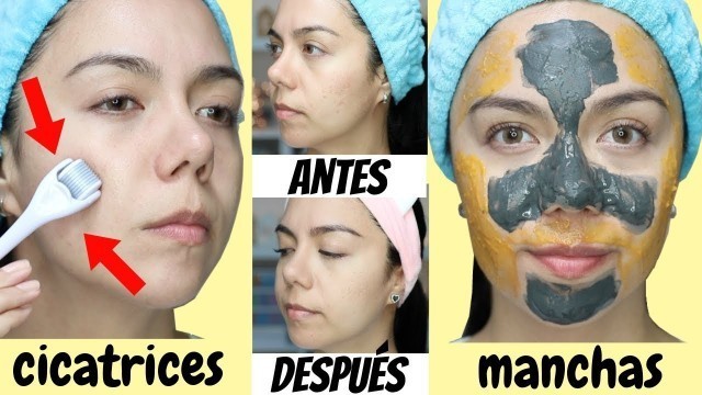 'MI RUTINA PARA BORRAR CICATRICES POR ACNÉ Y MANCHAS | MARIEBELLE COSMETICS'